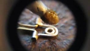 Clasp fabricating – IV