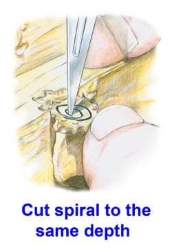 Spiral Cut Technique for Rubber Molds